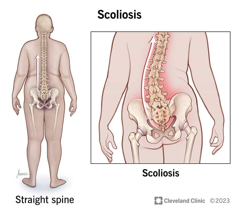 ABNORMAL CURVATURE OF THE SPINE - science illustration